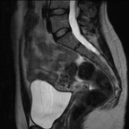 Volumineux fibrome sous-séreux pédiculé avec remaniements oedémateux Sagittal T2 Volumineux fibrome sous-séreux pédiculé avec remaniements oedémateux Sagittal T2