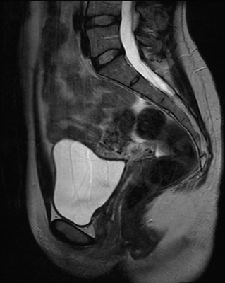 Volumineux fibrome sous-séreux pédiculé avec remaniements oedémateux Sagittal T2