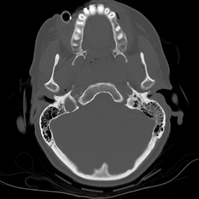 Craniocerebral trauma, Carotid artery injury with dissection, traumatic perforation of GI tract, pulmonary artery injury, Chance fracture Head CT and Cervical spine, Axial plane, Bone window