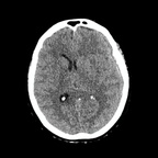 Hématome intra parenchymateux et hématome sous dural TDM Crâne Axial mm Fenêtre Tissus mous Hématome intra parenchymateux et hématome sous dural TDM Crâne Axial mm Fenêtre Tissus mous
