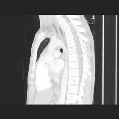 Pneumopathie infectieuse de la base droite Sagittal Parenchyme