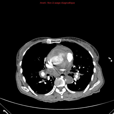 Rupture de l'aorte ascendante avec tamponnade sur hémopéricarde  TDM Thorax Axial Temps artériel pulmonaire