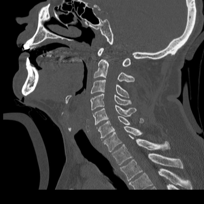 Subarachnoid Hemorrhage, Traumatic, Pneumothorax, Sternum fracture Cervical spine, Sagittal plane, Bone window
