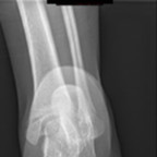 Syndrome de l'os naviculaire accessoire Radiographie pied gauche face Syndrome de l'os naviculaire accessoire Radiographie pied gauche face