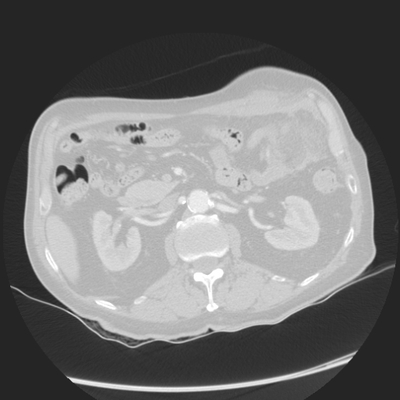 Injury of abdominal wall, Acute hemorrhage Chest, Abdomen and Pelvis, Lung window, Axial plane