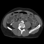 Diverticule de Meckel invaginé Entéroscanner axial temps portal Diverticule de Meckel invaginé Entéroscanner axial temps portal