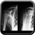 chondroblastome  Radiographie Membre supérieur