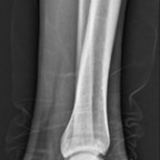 Lipoma of the calcaneus (stage 2) 1 Lipoma of the calcaneus (stage 2) 1