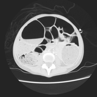 Occlusion mécanique colique sur endométriose digestive TDM Axial (air)