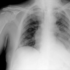 Lacher de ballons pulmonaire Thorax Lacher de ballons pulmonaire Thorax