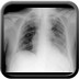 Lacher de ballons pulmonaire Thorax