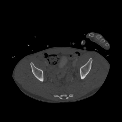 traumatisme cranien, fracture du massif facial, traumatisme thoracique, fracture pelvienne, traumatisme spléno-rénal bassin axial os