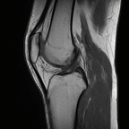 Plicae synoviale médiale IRM genou Sagittal T1 TSE Plicae synoviale médiale IRM genou Sagittal T1 TSE