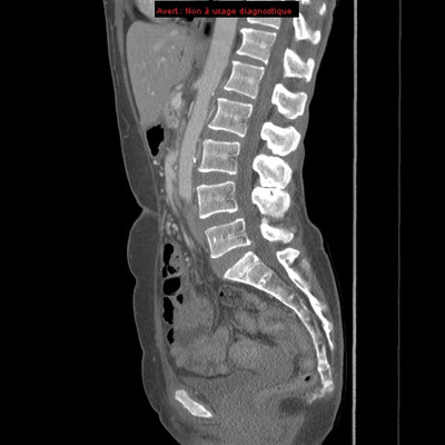Veine rénale gauche circumaortique  TDM Abdomen Sagittal Temps veineux