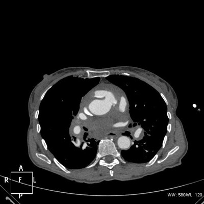 Rupture de l'aorte ascendante avec tamponnade sur hémopéricarde  TDM Thorax Axial Temps artériel aortique