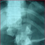 fracture type C de magerl image 1 fracture type C de magerl image 1