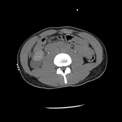 traumatisme cranien, oedème pulmonaire, lacération du rein abdomen tardif axial