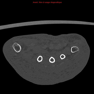 Chondrocalcinose  TDM Membre supérieur Axial