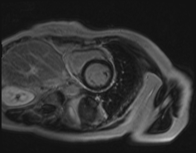 Syndrome de Tako-Tsubo - Myocardite adrénergique Rehaussement tardif - IR - Petit axe 1