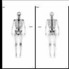 Scaro iliite inflammatoire dans le cadre d'une spondylarthropathie Scinti Scaro iliite inflammatoire dans le cadre d'une spondylarthropathie Scinti
