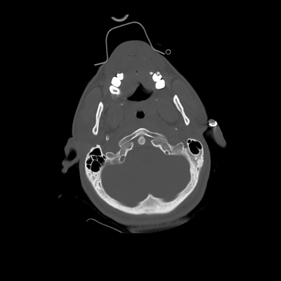 Thoracic Injuries, Subcapsular hemorrhage of liver, Pelvic injury Head CT, Bone window