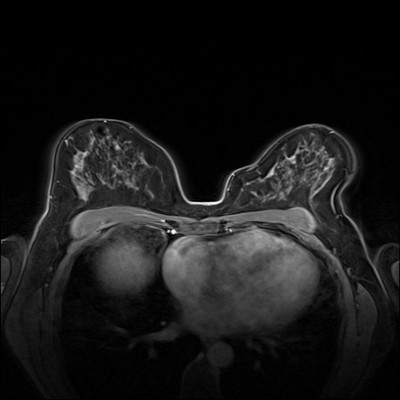 Carcinome canalaire in situ supéro-médian droit Dynamique FS 3 min