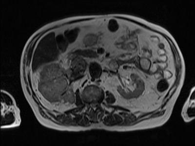 Adénocarcinome rénal droit avec envahissement de la veine rénale et de la VCI T2 axial