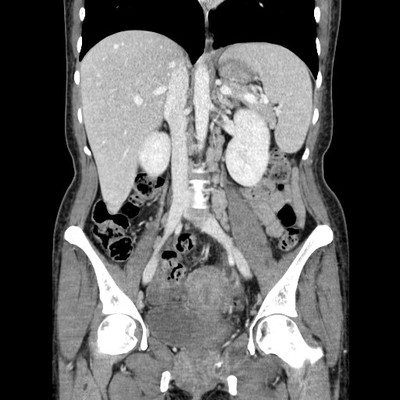 Tuberculose sacrée avec volumineux abcès Abdomen portal coronal
