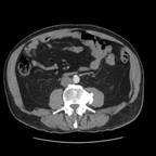 Infarctus massif du myocarde se manifestant par des douleurs abdominales TDM Abdomen Axial Temps artériel Infarctus massif du myocarde se manifestant par des douleurs abdominales TDM Abdomen Axial Temps artériel