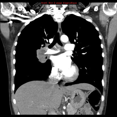Adénocarcinome pulmonaire avec contingent à cellules claires TDM Thorax Coronal Fenêtre Tissus mous