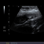 Appendicite aiguë avec péri-appendicite Echographie FID Appendicite aiguë avec péri-appendicite Echographie FID