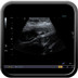 Appendicite aiguë avec péri-appendicite Echographie FID