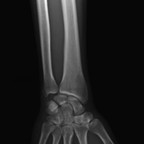 Acute calcific tendinitis of Flexor Carpi Ulnaris fig-01 Acute calcific tendinitis of Flexor Carpi Ulnaris fig-01