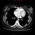 Veine cave supérieure gauche et retour veineux pulmonaire anormal partiel TDM Thorax Axial Temps artériel Veine cave supérieure gauche et retour veineux pulmonaire anormal partiel TDM Thorax Axial Temps artériel