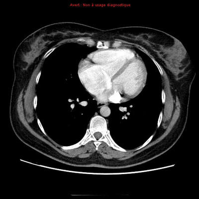 Veine cave supérieure gauche et retour veineux pulmonaire anormal partiel  TDM Thorax Axial Temps artériel