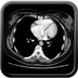 Veine cave supérieure gauche et retour veineux pulmonaire anormal partiel  TDM Thorax Axial Temps artériel