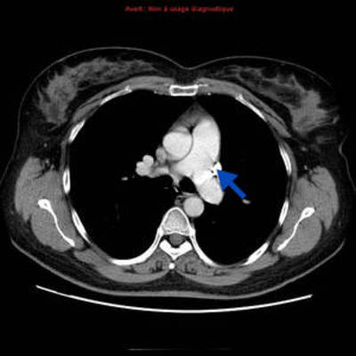 Veine cave supérieure gauche et retour veineux pulmonaire anormal partiel  TDM Thorax Axial Temps artériel