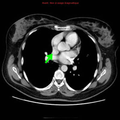 Veine cave supérieure gauche et retour veineux pulmonaire anormal partiel  TDM Thorax Axial Temps artériel