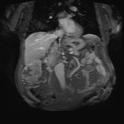 Adénocarcinome rénal droit avec envahissement de la veine rénale et de la VCI Coronal Portal post Gadolinium