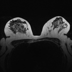 Carcinome canalaire infiltrant médio-externe de 8 mm avec du CCIS étendu à tout le quadrant inféro-externe et à une partie du quadrant supéro-externe droit. 2005 T2 Carcinome canalaire infiltrant médio-externe de 8 mm avec du CCIS étendu à tout le quadrant inféro-externe et à une partie du quadrant supéro-externe droit. 2005 T2