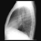 Scissure azygos Radiographie Thorax Scissure azygos Radiographie Thorax