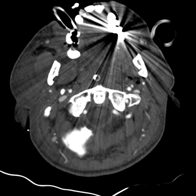 Severe cranioencephalic injuries, Carotid artery dissection, Aspiration pneumonia, Pelvic fracture Neck vessels, Axial plane