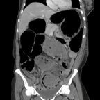 Volvulus du sigmoïde TDM Abdomen Pelvis Coronal Portal Volvulus du sigmoïde TDM Abdomen Pelvis Coronal Portal