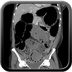 Volvulus du sigmoïde TDM Abdomen Pelvis Coronal Portal