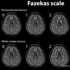 Fazekas scale in ARWMC scale on MRI fazekas-scale Fazekas scale in ARWMC scale on MRI fazekas-scale
