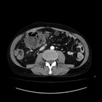 Lymphome digestif, hépatique, rénal et pancréatique chez un malade porteur d'un Crohn traité par Imurel TDM Abdomen Axial Temps veineux Lymphome digestif, hépatique, rénal et pancréatique chez un malade porteur d'un Crohn traité par Imurel TDM Abdomen Axial Temps veineux