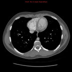Hereditary hemorrhagic telangiectasia with lung arteriovenous malformation CT Thorax Axial Arterial phase Hereditary hemorrhagic telangiectasia with lung arteriovenous malformation CT Thorax Axial Arterial phase