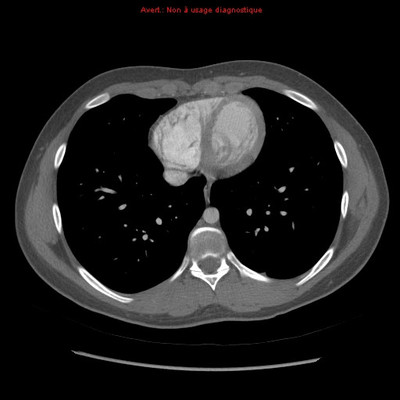 Hereditary hemorrhagic telangiectasia with lung arteriovenous malformation  CT Thorax Axial Arterial phase