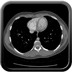 Maladie de Rendu Osler avec malformations artérioveineuses pulmonaires embolisées  TDM Thorax Axial Temps artériel fenêtre vasculaire