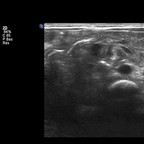 Anomalie de rotation du mésentère compliquée de volvulus Echographie Anomalie de rotation du mésentère compliquée de volvulus Echographie